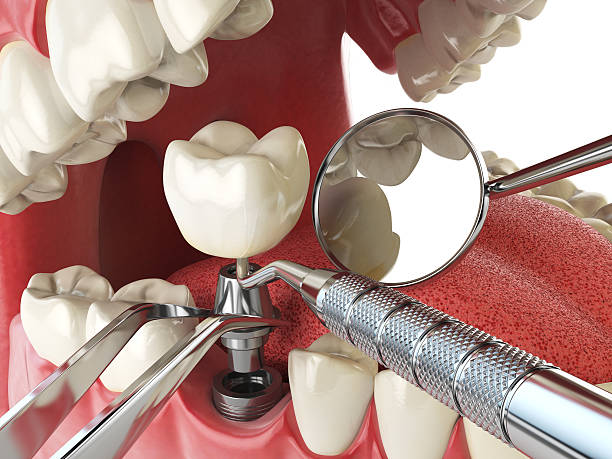 Urgent Tooth Repair in OK